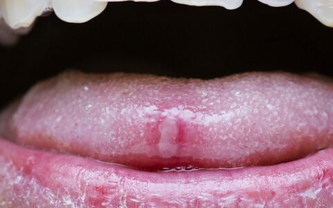 牙齿“刮”舌头？警惕舌癌！