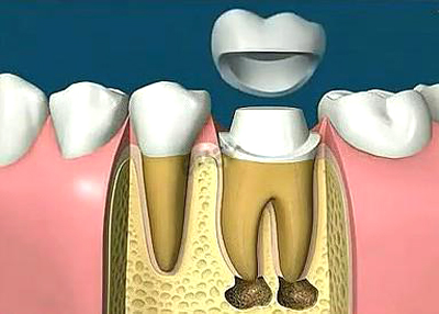 根管治疗后的牙齿，还能用多久？