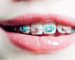 牙套上的橡皮筋，才是你牙齿变美的关键！