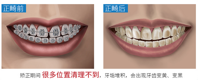 告别牙齿矫正麻烦事！教你口腔护理用品怎么选！